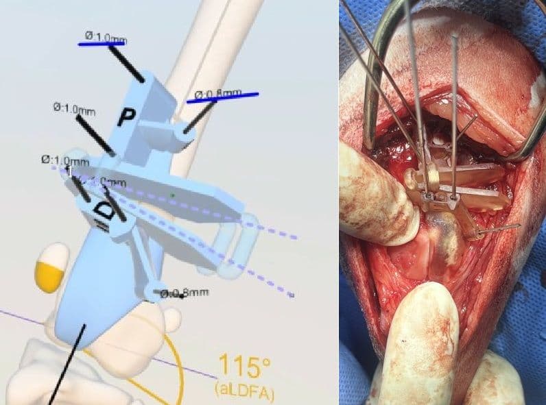 3D Print 기반 각기형 교정술