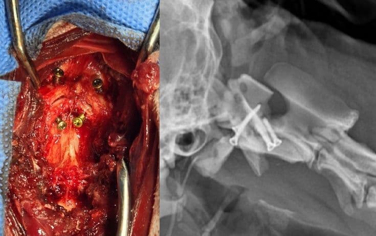 환축추아탈구(AAI) 교정술