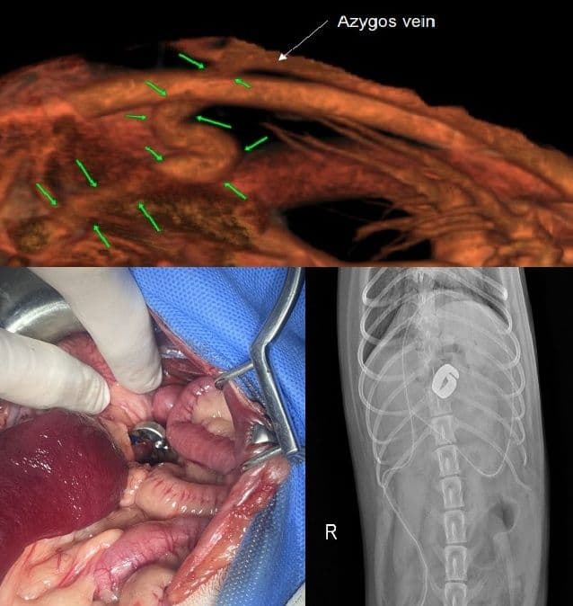 PSS (간문맥 전신 단락)